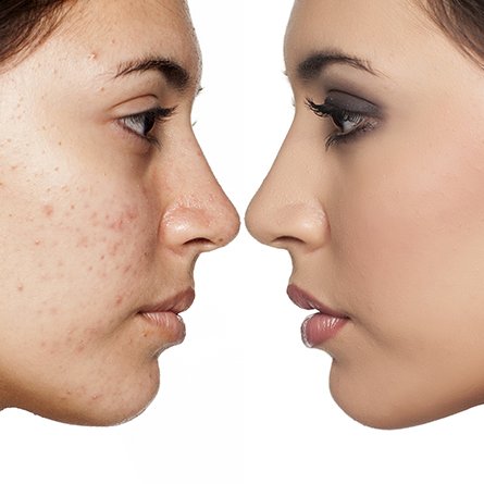 Acne Treatment Course