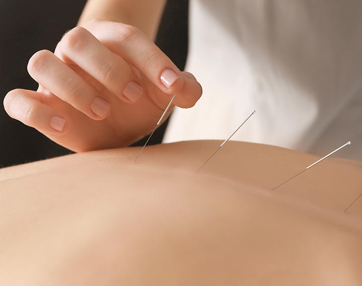 Medical Acupuncture | LC Aesthetics Academy